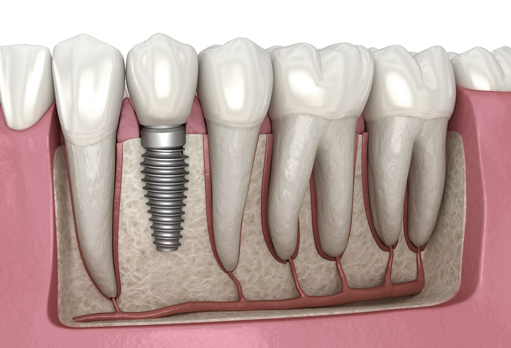 implant